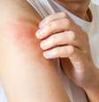 Infecções por fungos crescem mais de 42% nos meses quentes  Foto: Shutterstock / Saúde em Dia
