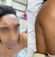 Wellington Valério teve o ombro quebrado e a testa durante a confusão  Foto: Arquivo pessoal