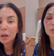 Ivete Sangalo com o rosto inchado após cirurgia  Foto: Reprodução/Instagram