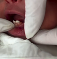 Bebê nasce com dentes no ES e passa por cirurgia para retirada; a cirurgiã-dentista Julia Emery revelou que o caso é considerado raro  Foto: Reprodução/Instagram/@dra.juliaemery