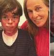 O que é epidermólise bolhosa, condição que vitimou neto de coreógrafa aos 14 anos  Foto: Reprodução/@deborahcolker/Instagram | Reprodução/DEBRA UK