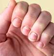 Manchinhas brancas nas unhas? Na maioria das vezes, não é falta de cálcio -depositphotos.com / natali_ploskaya  Foto: Giro 10