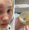 Menina sofre queimaduras após fazer trend do TikTok  Foto: Reprodução/Facebook/The Hartcliffe Dingles