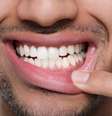 Boca seca, gengivas inflamadas e perda dentária podem ser sinais iniciais de diabetes  Foto: Shutterstock / Saúde em Dia