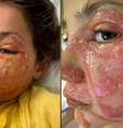 Violet Zerbst, de 10 anos, passou uma semana em um hospital de Gold Coast depois de aquecer um brinquedo mole em um microondas antes de apertá-lo Foto: Reprodução/7News