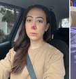 A repórter da Globo Ju Massaoka relatou regressão no tratamento de ferida no nariz causada por aplicação de PMMA  Foto: Reprodução/Instagram