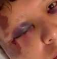 O turista mexicano Kevin Jonoel teve graves hematomas nos olhos e em todo o rosto.  Foto: Reprodução/ Redes Sociais