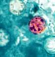 Parasita microscópico 'Cyclospora cayetanensis' provoca diarreia 'explosiva', que é aquosa e com evacuações frequentes Foto: Divulgação/CDC/DPDx/Melanie Moser