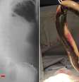 Enguia media 65 cm e estava viva Foto: Reprodução/International Journal of Surgery Case Reports