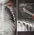 Radiografia de bebê de cerca de 50 dias mostram as fraturas; pai foi preso por maus-tratos.  Foto: Reprodução/ TV Globo