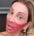 Maya Massafera aparece com o rosto queimado  Foto: Reprodução/Instagram