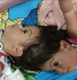 Morrem as gêmeas Helena e Heloísa, que nasceram unidas pela cabeça Foto: Reprodução/EPTV