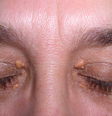 Manchas e protuberâncias amareladas nos olhos são chamadas de xantelasma  Foto: Wikimedia