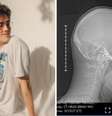 Jake Luppen anunciou que fará cirurgia para retirar tumor cerebral e ficará acordado durante procedimento Foto: Reprodução/Instagram