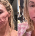Brandi Glanville ficou com o rosto deformado por conta de suposto parasita Foto: Reprodução/Instagram