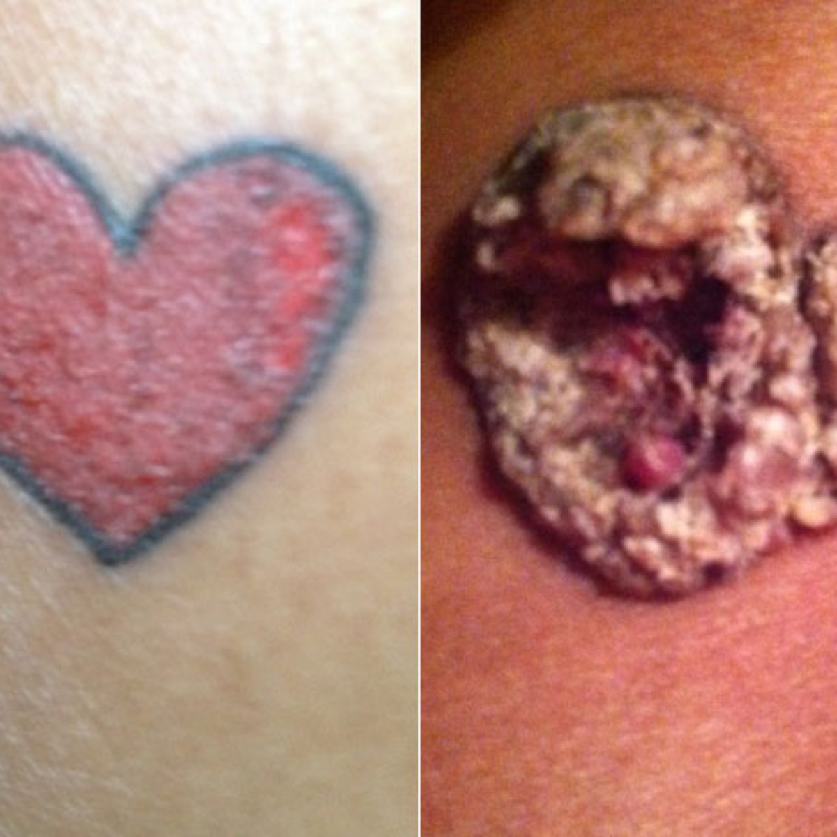 Alergia na tatuagem depois de muito tempo 10 Cuidados Com A Pele Que Voce Deve Ter Depois De Fazer Uma Tatuagem Claudia