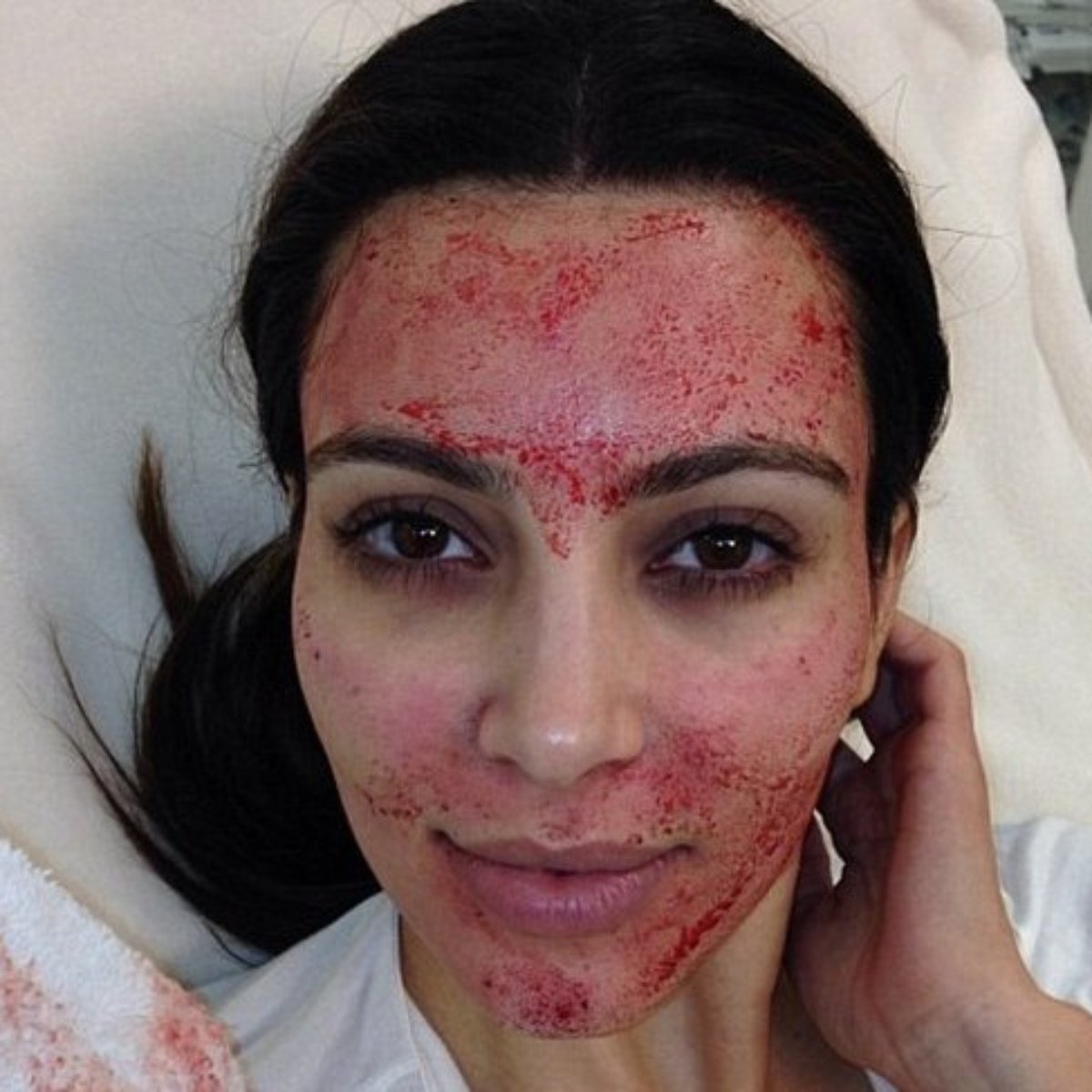 Dica de Kim Kardashian, Facelift de Vampiro deixa pele jovem