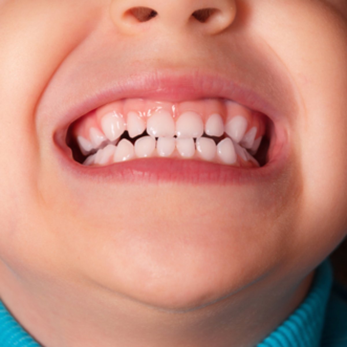 Dentes Pequenos Demais Ou Grandes Demais Saiba Como Tratar Sonhar com dente encavalado significados. dentes pequenos demais ou grandes
