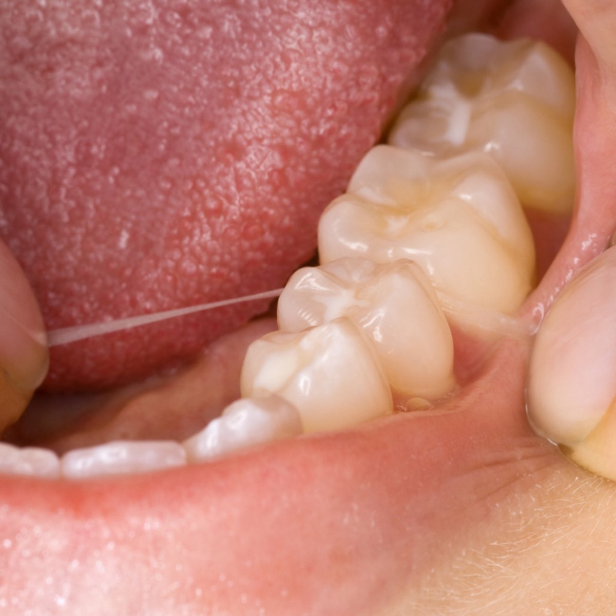 Por Que O Dente Do Siso So Nasce Em Adultos Os dentes permanentes são aqueles que vêm substituir os dentes de leite. o dente do siso so nasce em adultos
