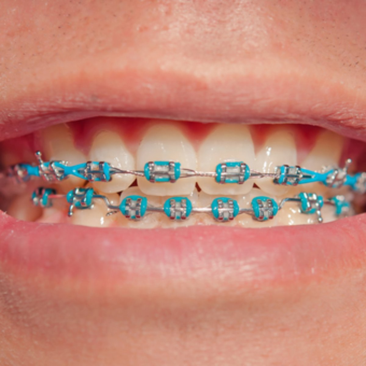 Vale A Pena Colocar Aparelho Depois Dos 30 Anos