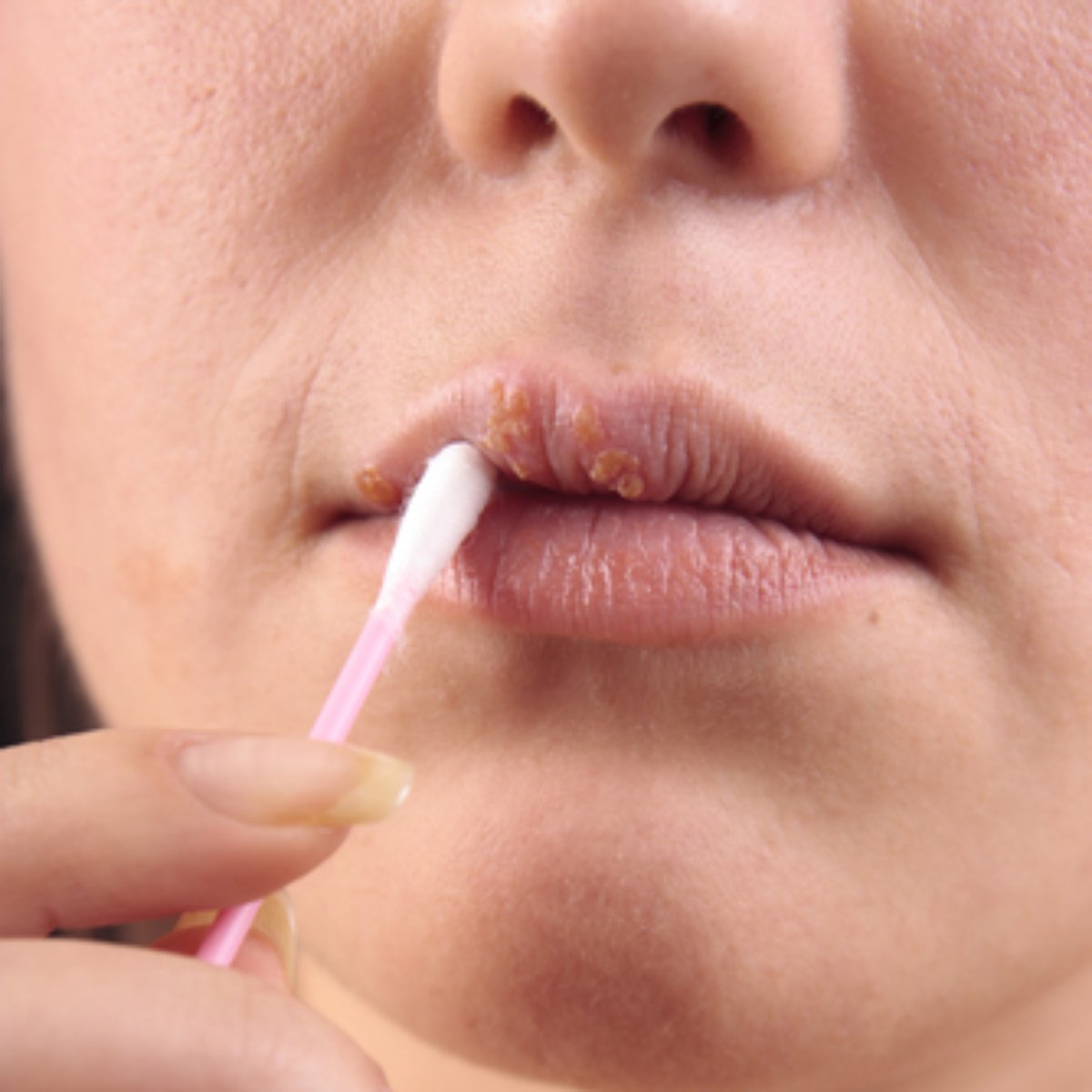 Fuja Conheca Fatores Que Favorecem O Aparecimento Do Herpes