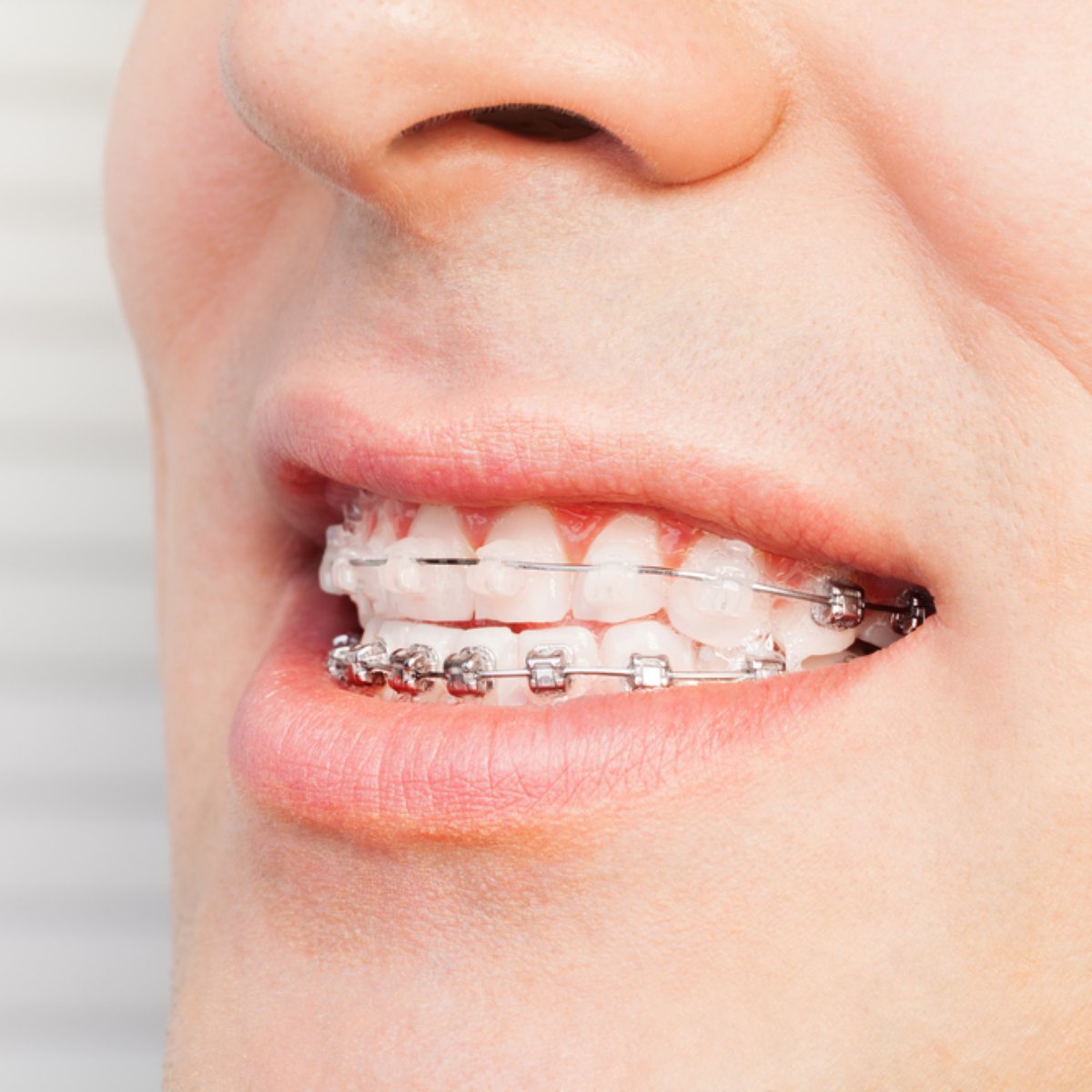 Existe Um Limite De Idade Para Iniciar Tratamento Ortodontico Ou seja, falsas amizades, já que amigos de verdade são sonho com dente caindo pode ser morte de pessoa conhecida ou parente próximo. limite de idade para iniciar tratamento