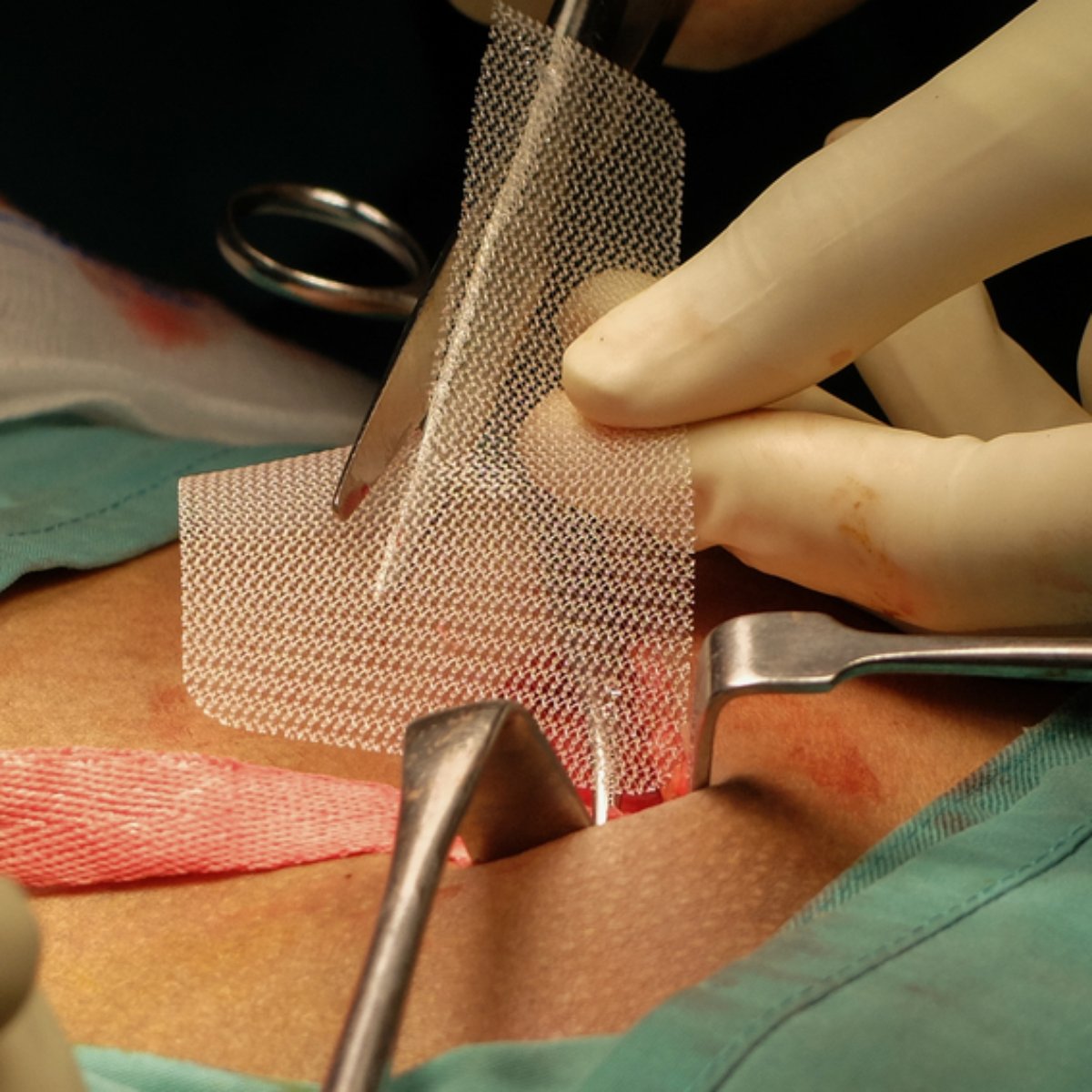 Recomendacoes Ineditas Para O Tratamento De Hernia Serao Apresentadas Em Foz Do Iguacu