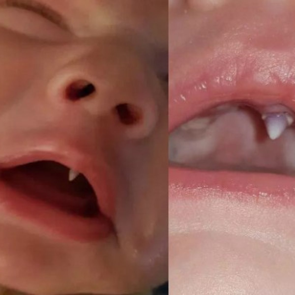 Crianca Nasce Com Dente De Vampiro E Assusta A Familia