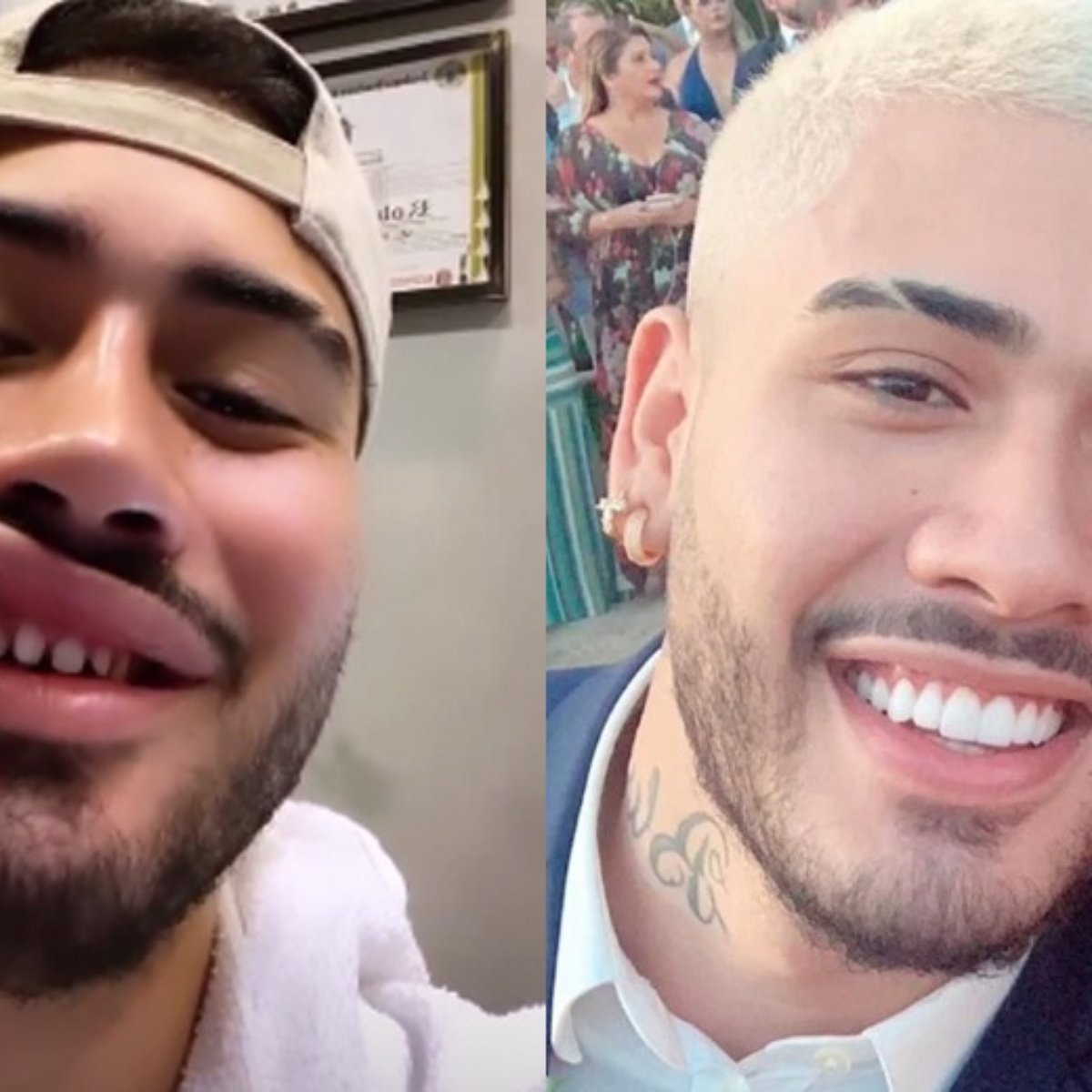 Lente De Contato Dental Conheca O Procedimento Feito Pelo Cantor Kevinho