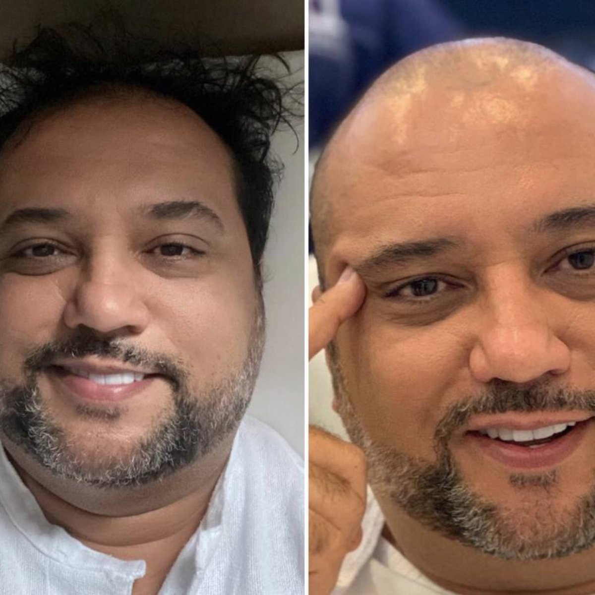 Geraldo Luis Passa Por Transplante Capilar Minha Calvicie Era Clara E Gritante