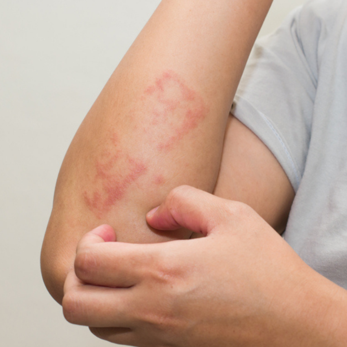 doencas de pele estresse e ansiedade podem causar irritacoes no corpo