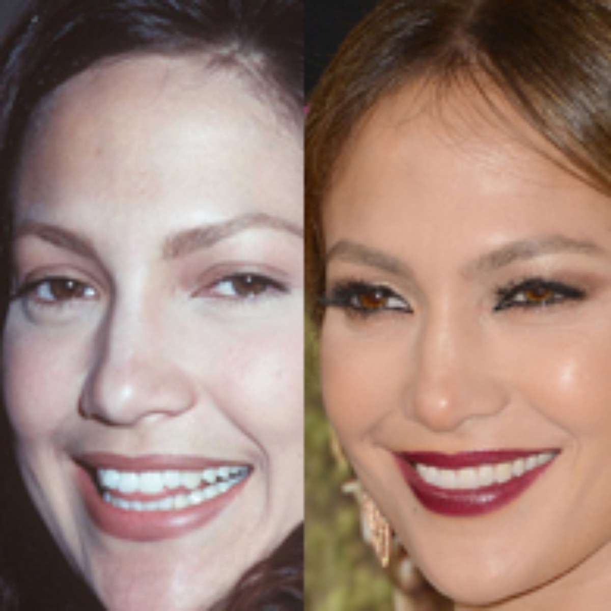 Veja 20 famosos que buscaram tratamento para mudar o sorriso