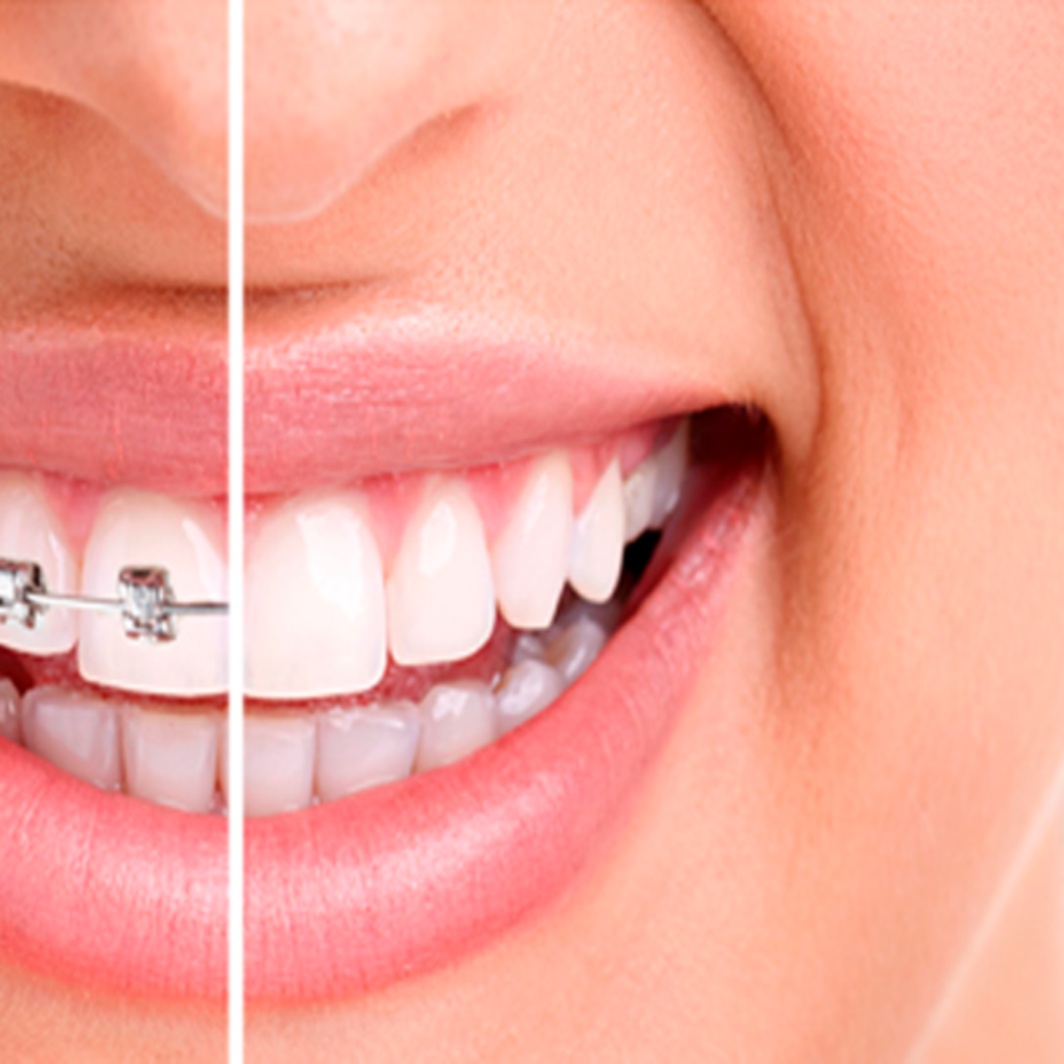 Aparelho Branco Para Dentes