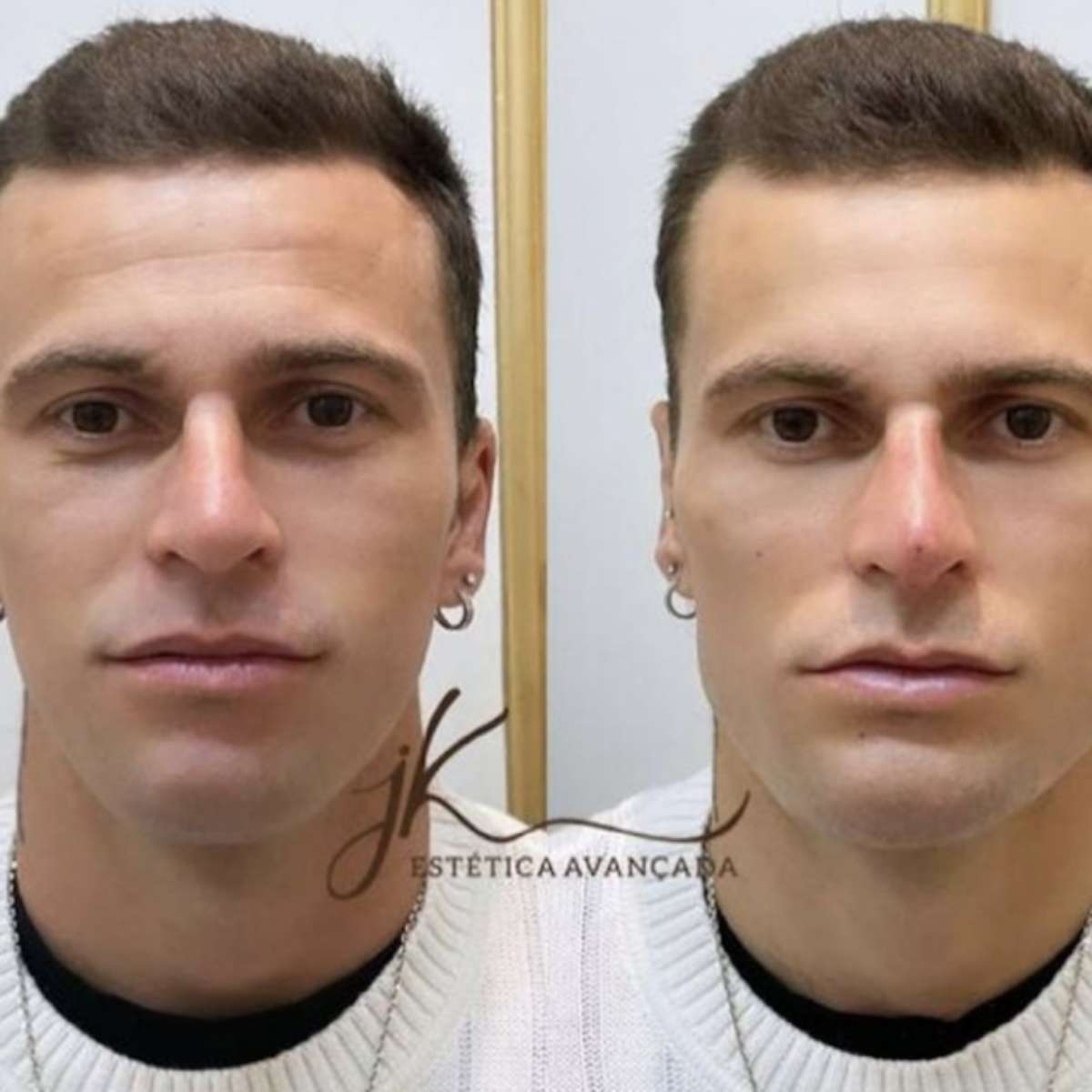 Lucas Lima faz harmonização facial e fica 'irreconhecível'; veja o antes e  depois