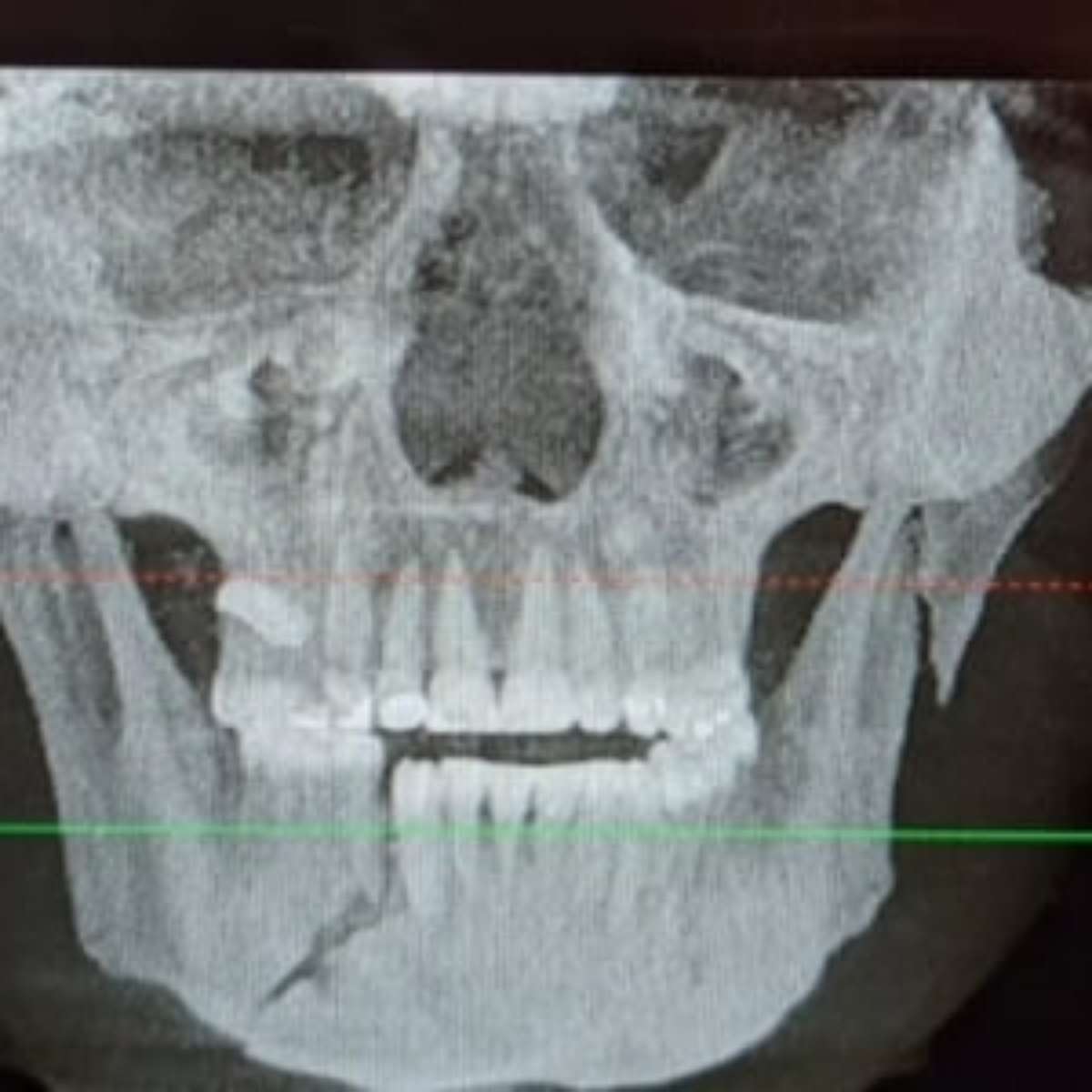 acidente maxilar e mandibula