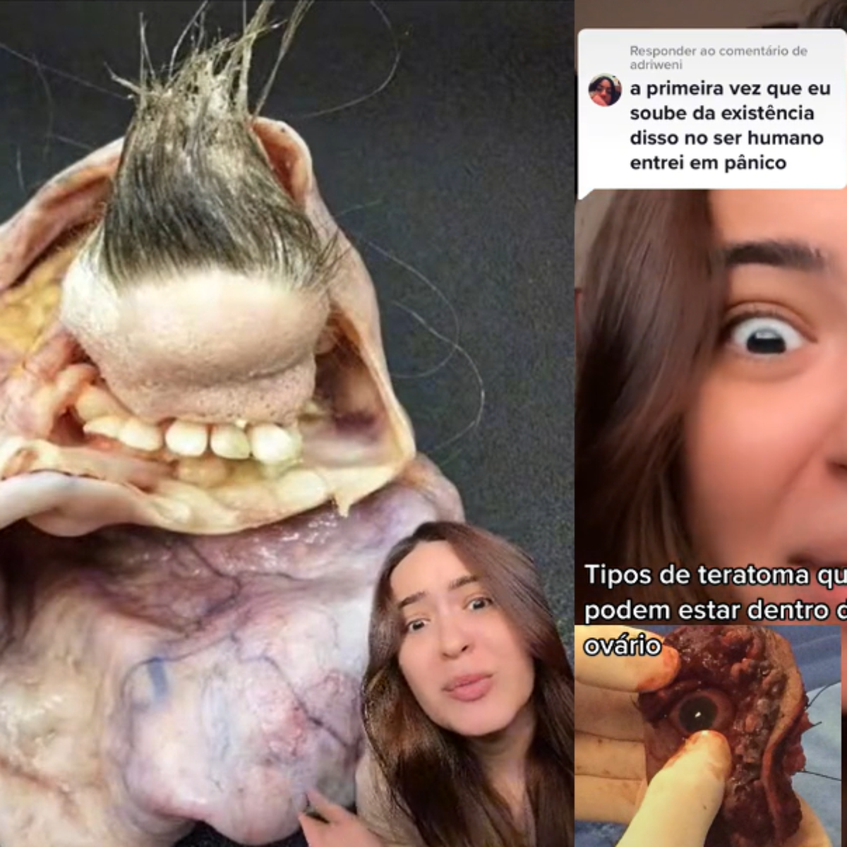 Cisto Ovariano Com Cabelo E Dentes