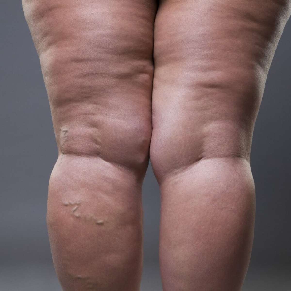 Lipedema: saiba o que causa o acúmulo de gordura no corpo