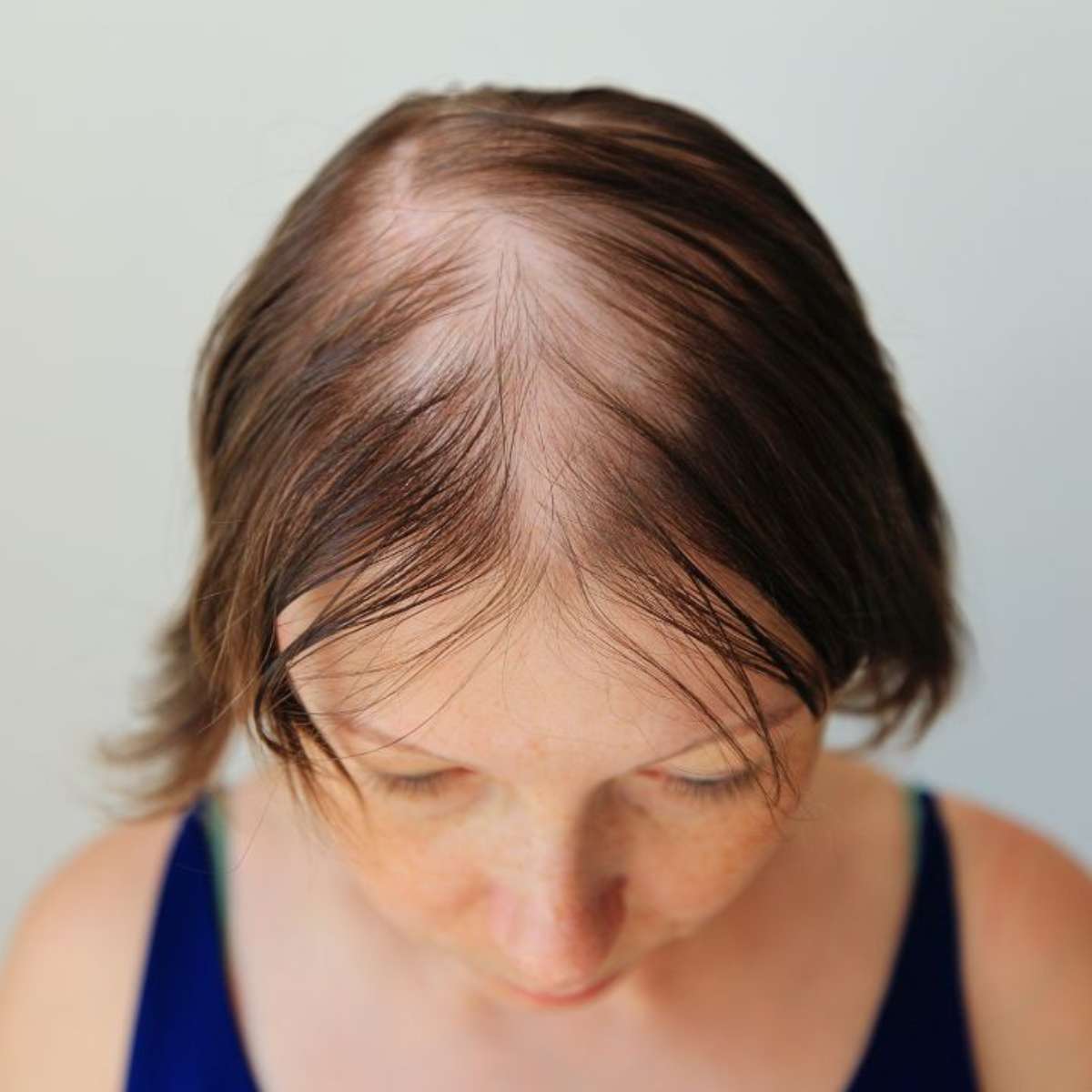 Alopecia: saiba 7 sinais que indicam o surgimento da doença
