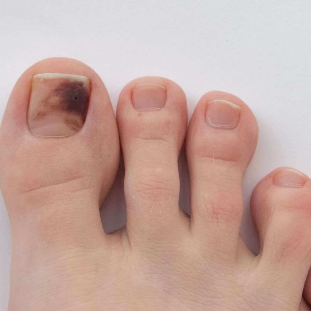 O que as suas unhas revelam sobre a sua saúde? Saiba identificar