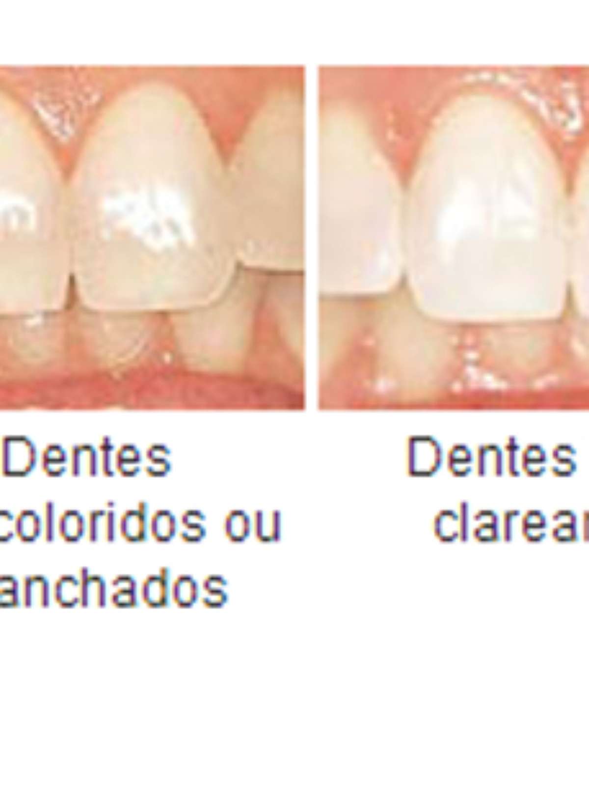 Sonhar com dente caindo significa morte? Veja significado bíblico e entenda