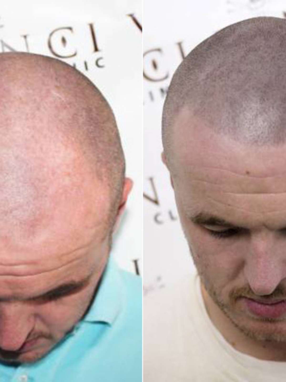 Homem calvo faz tatuagem no lugar do cabelo e viraliza na web: 'Lindo  demais