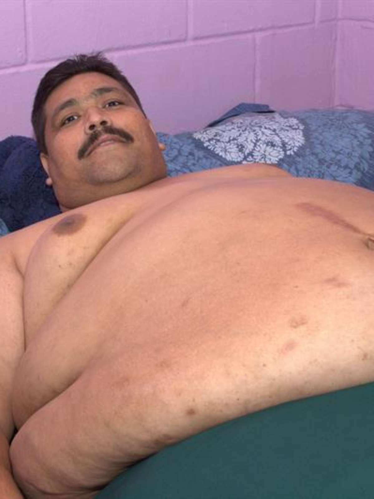 Homem mais obeso do mundo deve perder 355 quilos