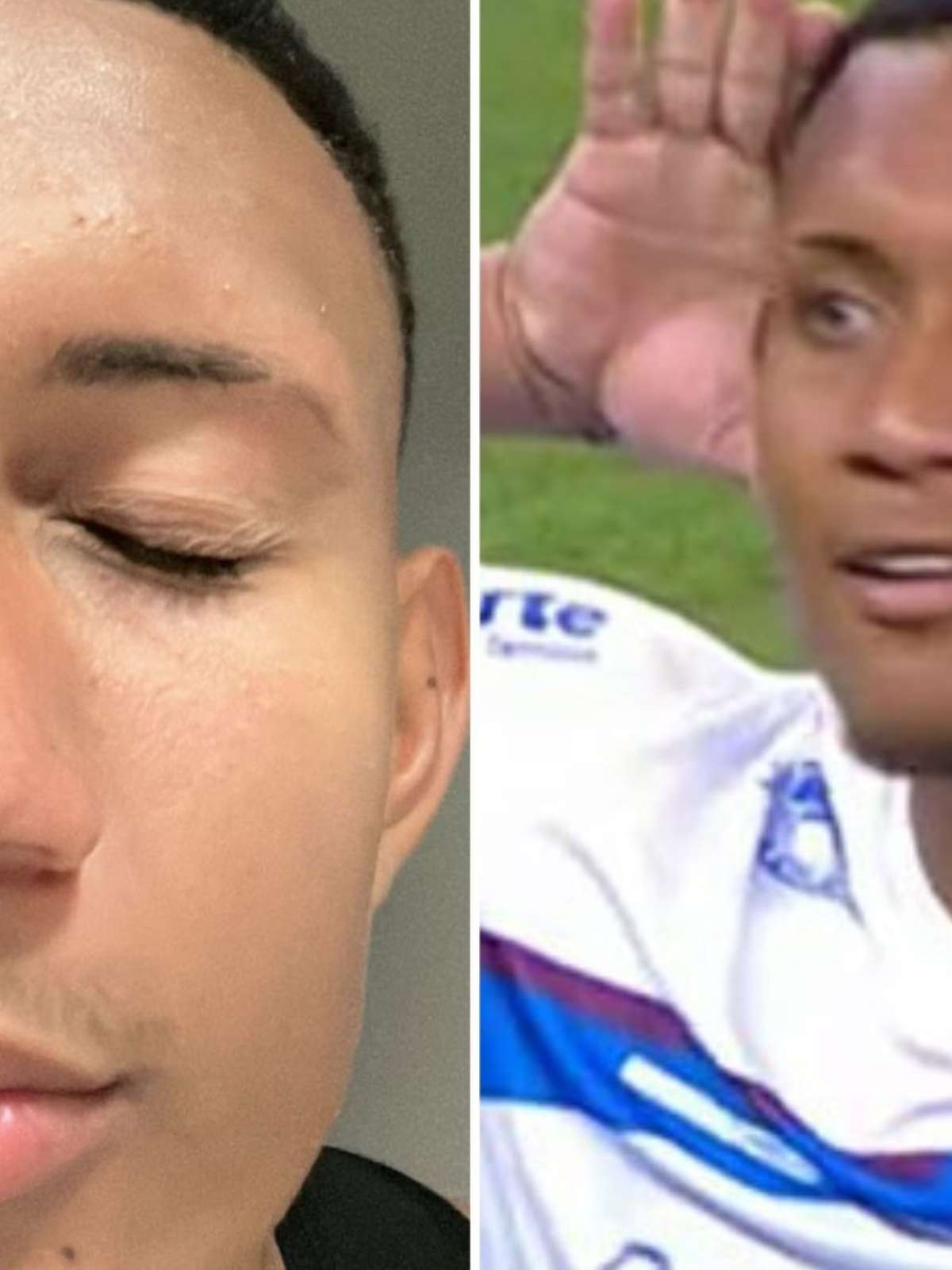 Herói da classificação do Caxias sobre o Internacional, atacante exibe  fratura sofrida no rosto após confusão - Esportes - R7 Lance