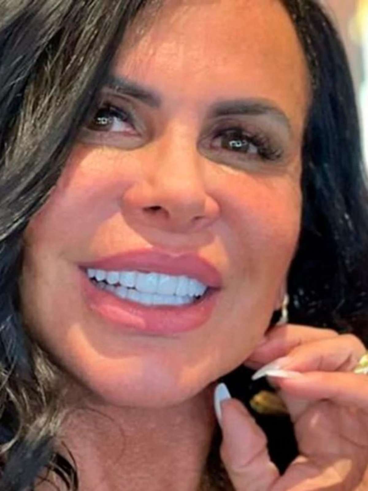 Harmonização facial: a nova mania que conquistou Gretchen e muita