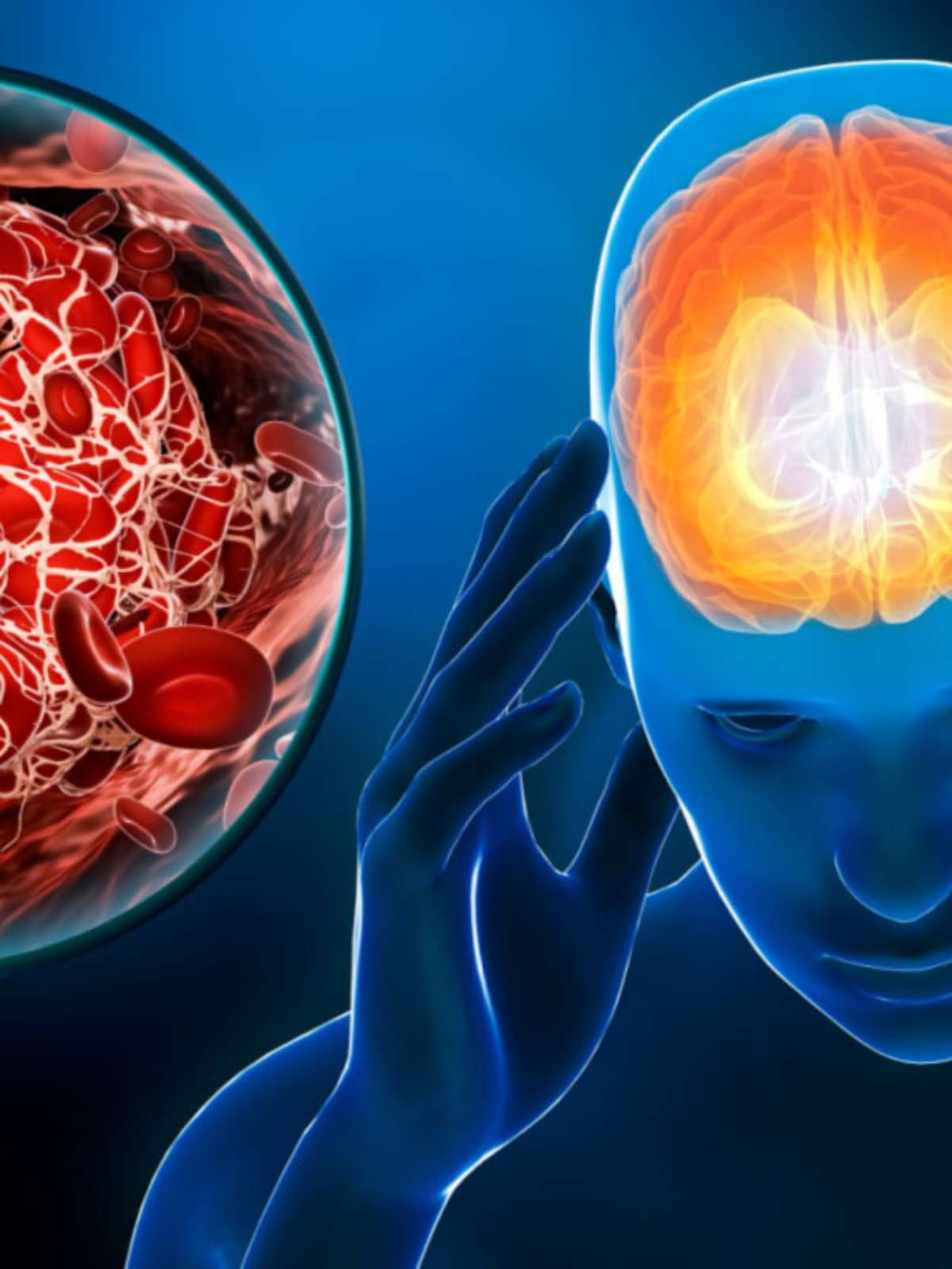 Acidente Vascular Cerebral e Outras Doenças Cerebrovasculares o