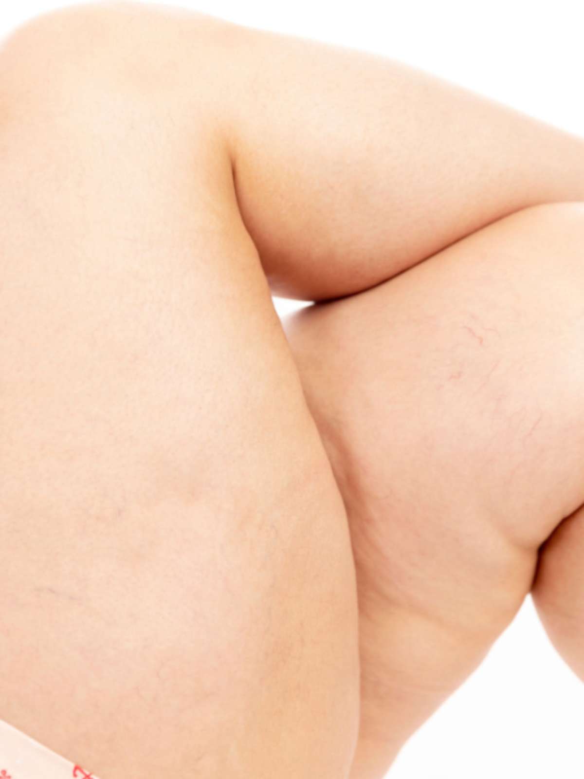 Lipedema ou celulite? Especialista explica as diferenças entre as