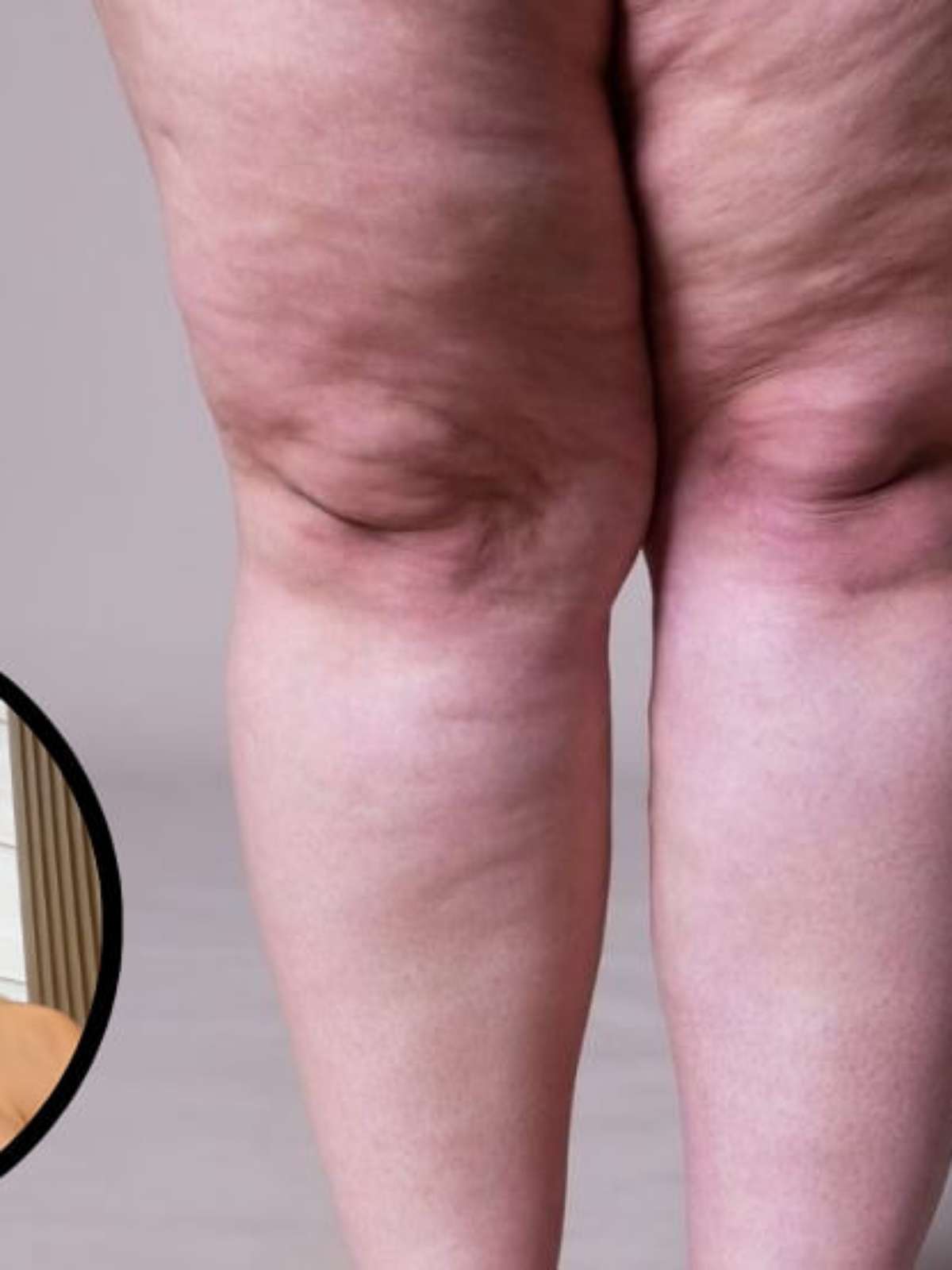 Mulheres com lipedema e varizes: o que tratar primeiro?