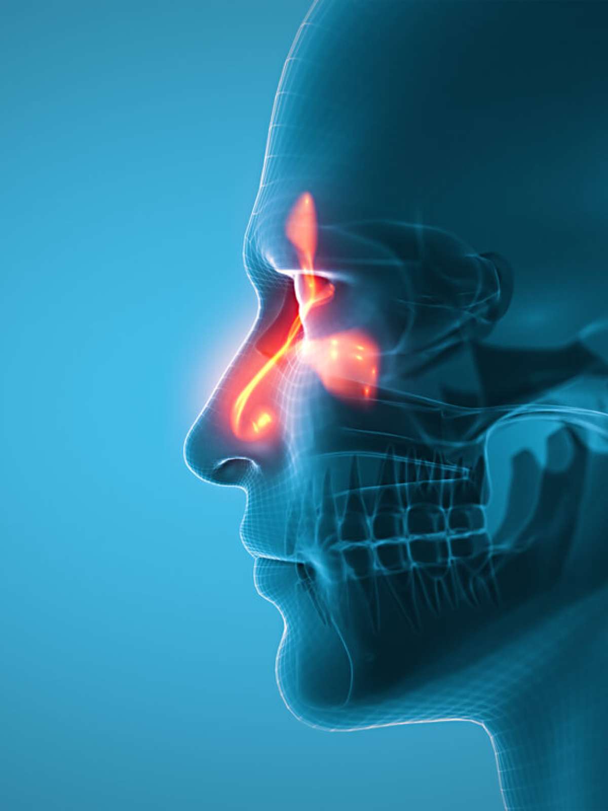 Sinusite pode matar: veja quais os sinais de agravamento da doença