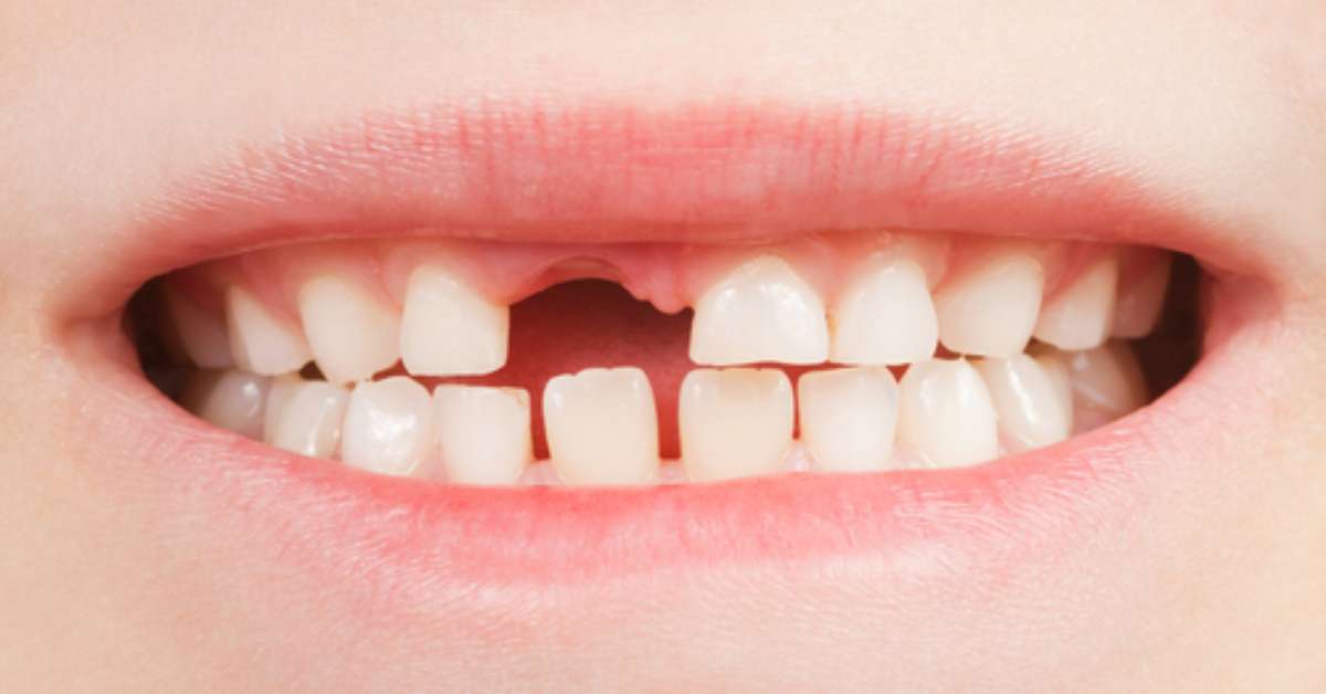 ¿Por qué expertos están extraer los dientes de leche? ¿Por qué expertos están extraer los dientes de leche?