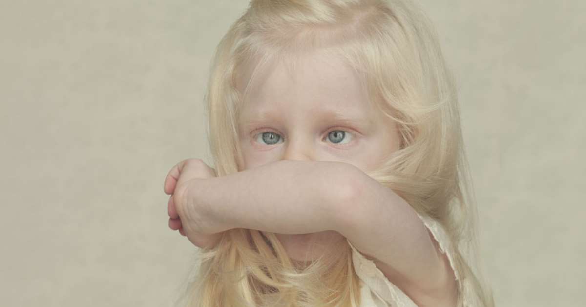 Afrodescentes E Indigenas Podem Ter Albinismo